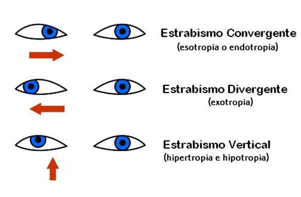 tratamientos-visuales_image029