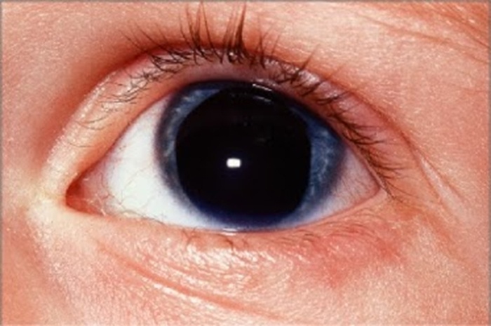 ¿Conocías estas enfermedades oculares?