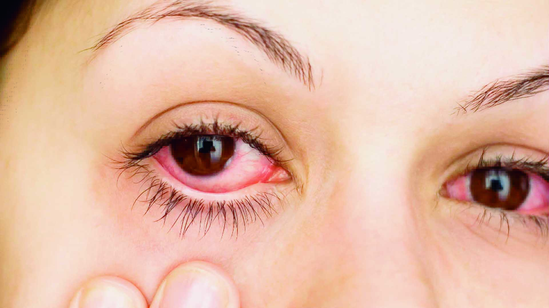 Las alergias y los ojos